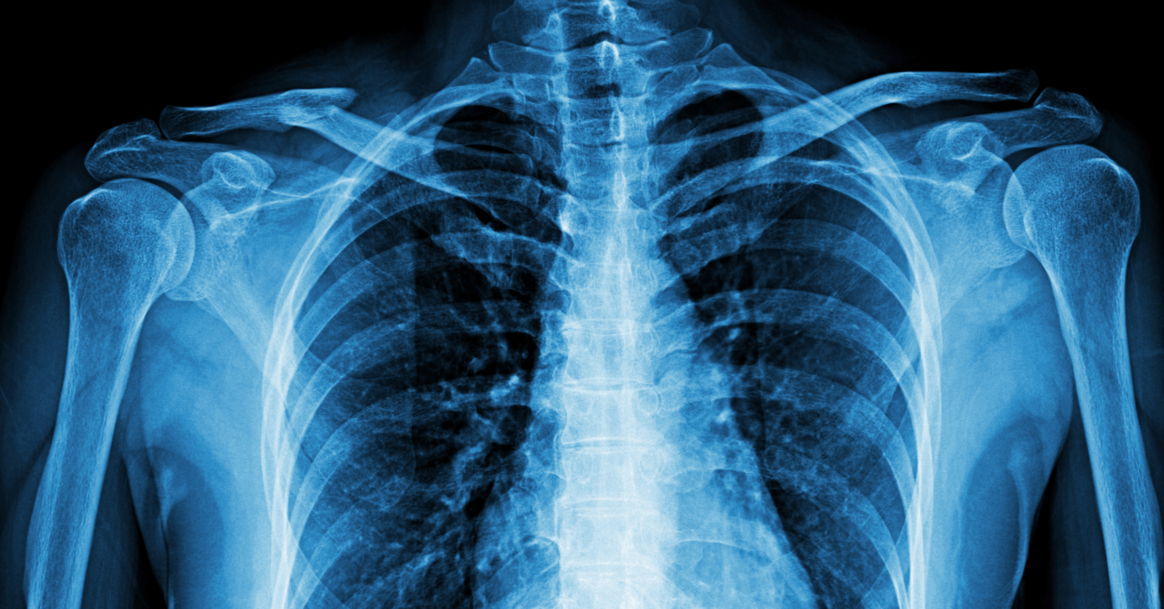 An edited X-ray image of a human chest, displaying the ribcage, spine, and shoulder bones. The ribs curve around the chest cavity, and the spine runs vertically through the center. The shoulder joints and upper arms are visible on either side, providing a detailed view of human anatomy.